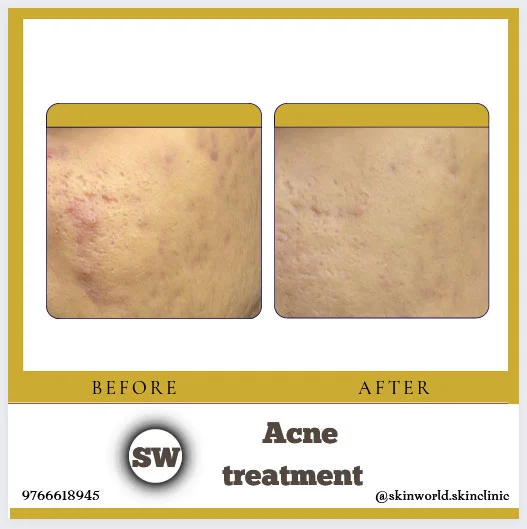 Acne Treatment