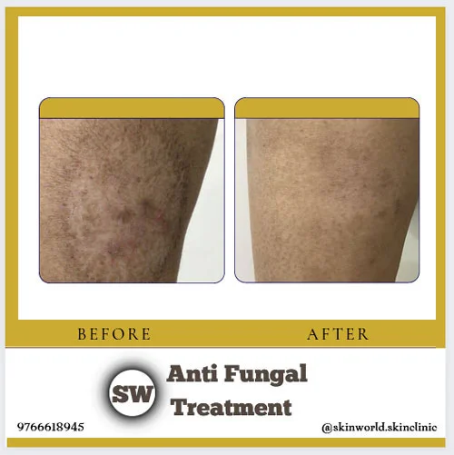 Anti Fungal Treatment