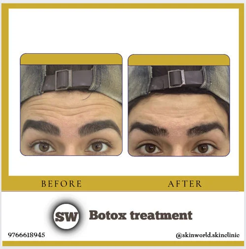 Botox Treatment