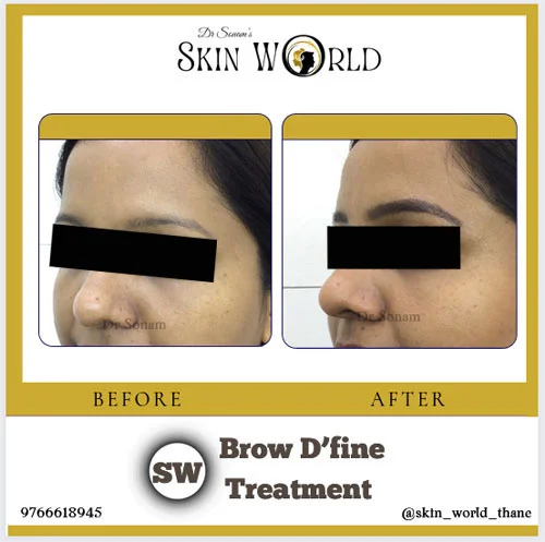 Brow Define Treatment