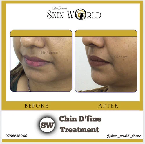 Chin Define Treatment