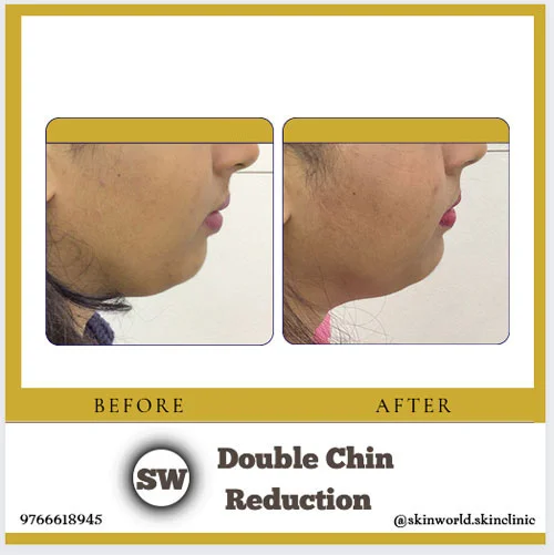 Double Chin Reduction