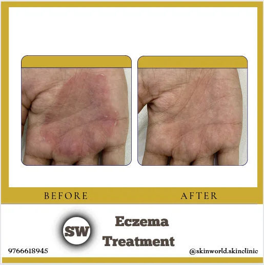 Eczema Treatment