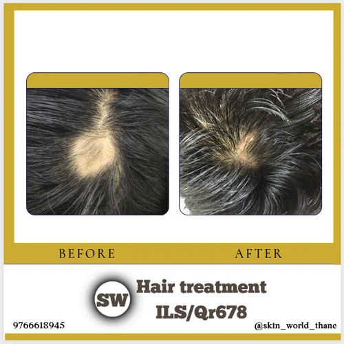 Hair Treatment ILS